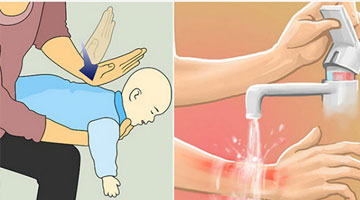 Sai lầm khi sơ cứu đa số người mắc phải